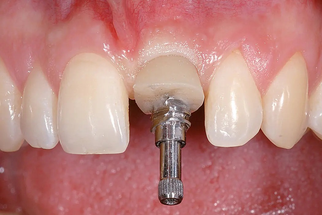 Dental Implants Navi Mumbai